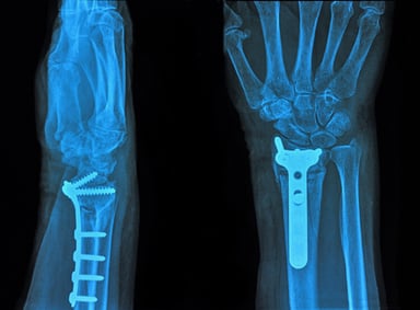 Evaluating-Magnesium-Based-Medical-Devices-in-Preclinical-Studies-bone-img